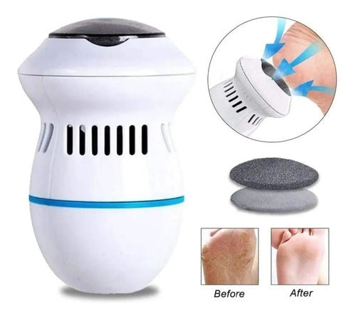 Removedor De Callos Automático